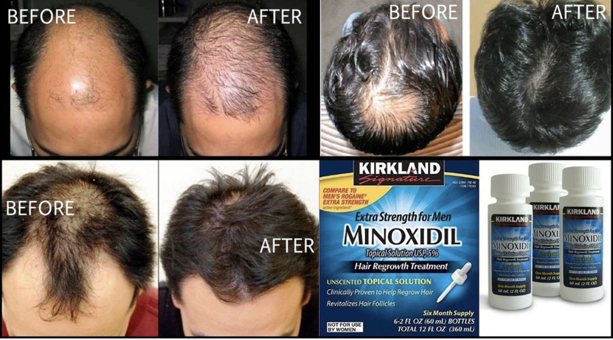 Minoxidil