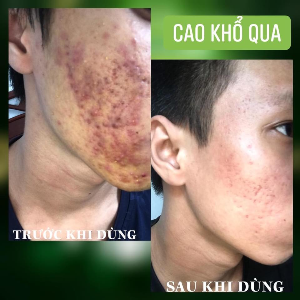 Cao Khổ Qua soHERBs