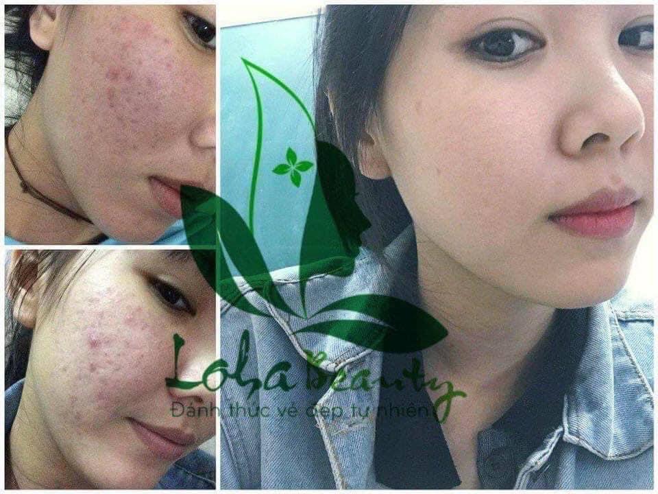 Combo Tinh chất tái tạo da loha 100ml (3 món như hình)