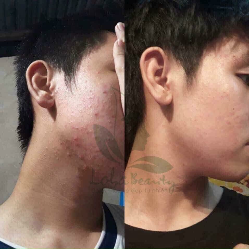 Combo Tinh chất tái tạo da loha 100ml (3 món như hình)