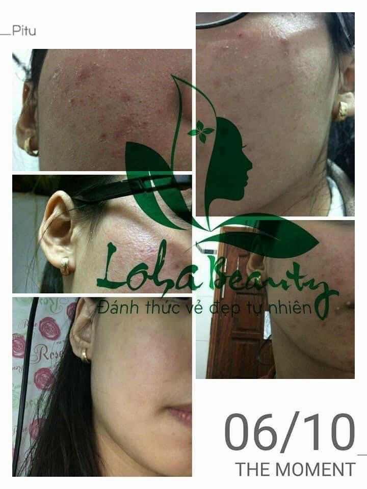 Tinh chất tái tạo da loha 100ml tặng toner