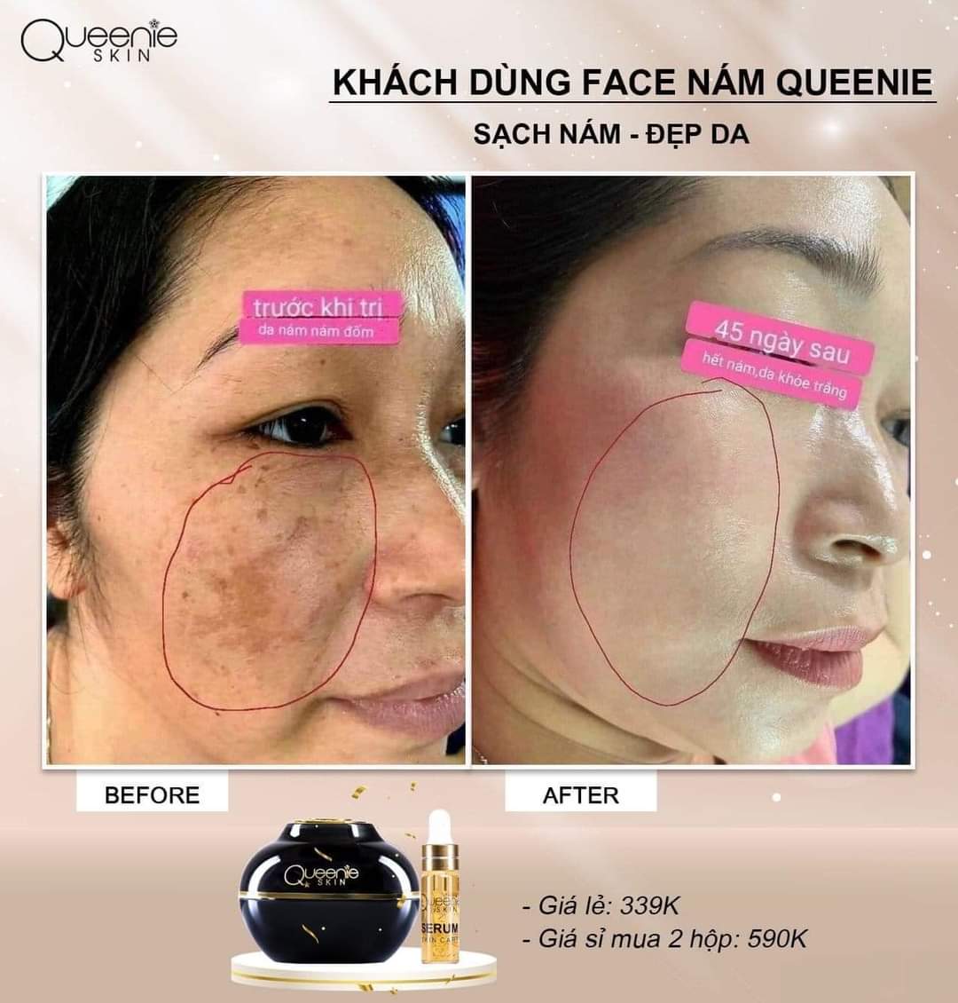 Kem làm mờ nám, tàn nhang