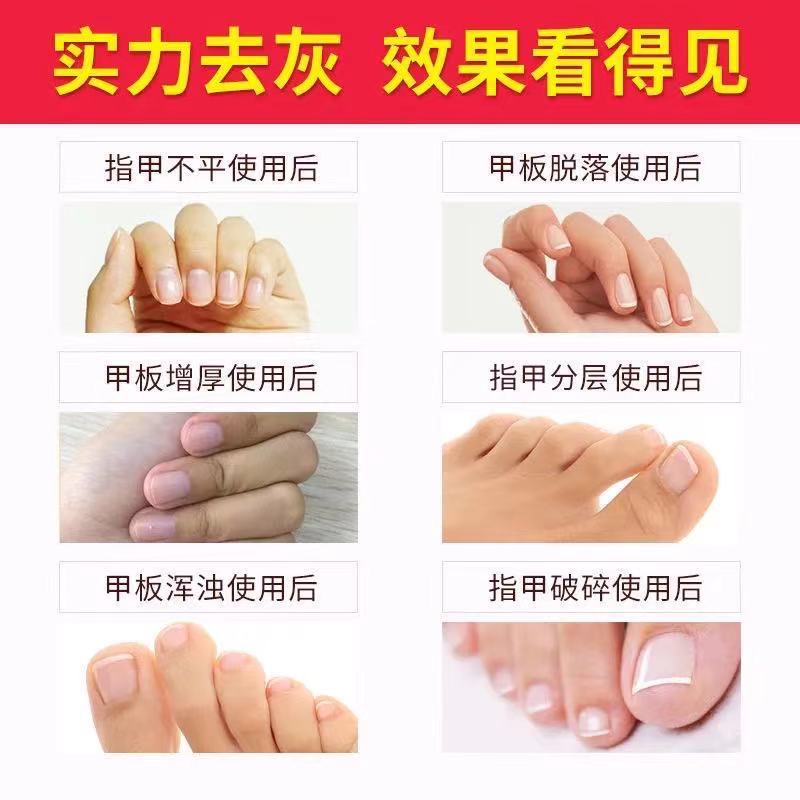 %E3%80%90Fashion-forward%E3%80%91Processing%20of%20onychomycosis%20health%20care%20liquid%20onychomycosis%20net%20toe%20onychomycosis%20care%20liquid%20foot%20suit%20-%20Image%203