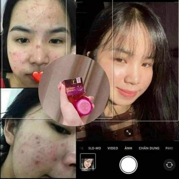 Combo 5 Hộp Kem Mụn Trắng Da 2C