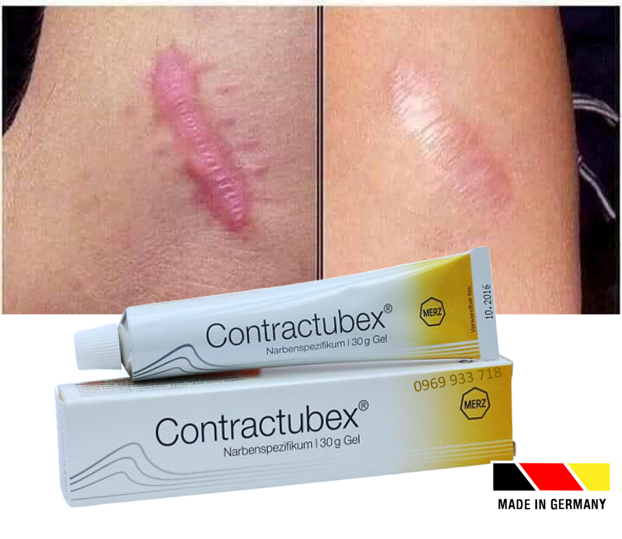 Kem làm mờ sẹo lồi, sẹo phì đại Contractubex 30g, Đức