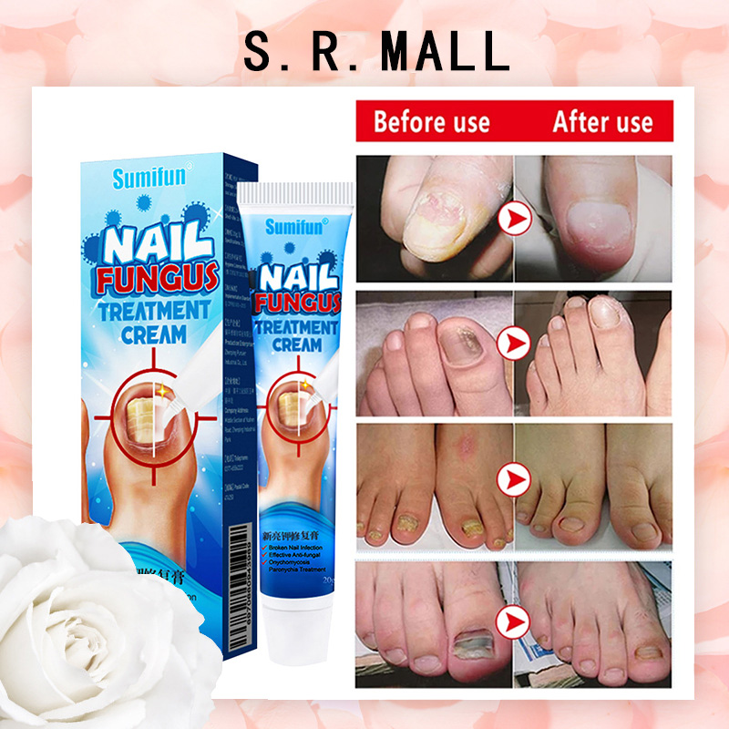 Nail Repair Cream Nail Fungal Treatment Gel Onychomycosis Paronychia