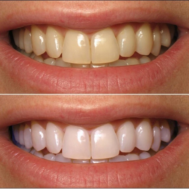 Kem Đánh Răng Và Bột Làm Trắng Răng Eucryl Toothpowder