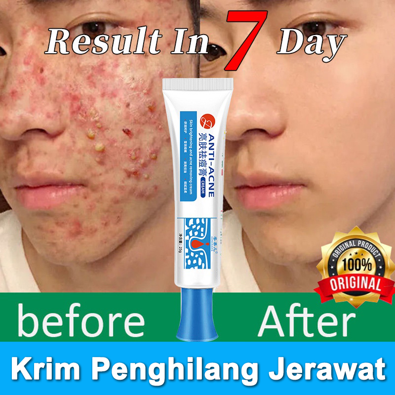 Krim Penghilang Jerawat Salep Jerawatanti Bakteri Krim Acne Treatment ...