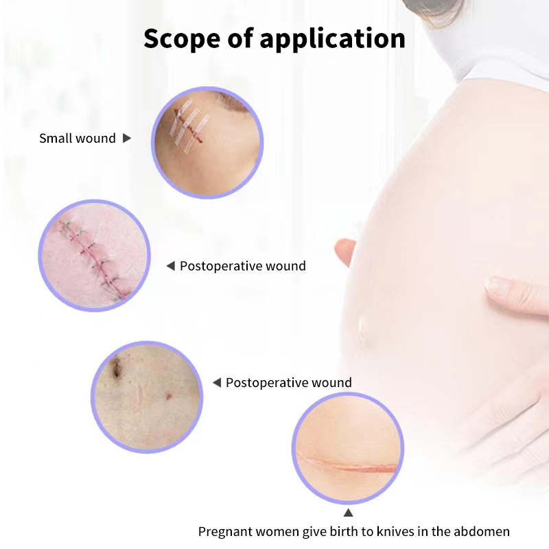 Stitch%20Free%20Adhesive%20Tape%20For%20Medical%20Wound%20Closure%20Strips%20Surgical%20Sutures%20Postpartum%20Wound%20Repair%20Cosmetic%20Adhesive%20Medical%20ZHIXING%20-%20Image%205