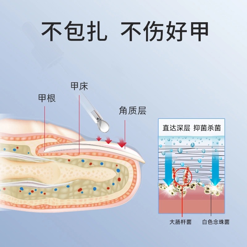%E3%80%90Fashion-forward%E3%80%91Processing%20of%20onychomycosis%20health%20care%20liquid%20onychomycosis%20net%20toe%20onychomycosis%20care%20liquid%20foot%20suit%20-%20Image%204