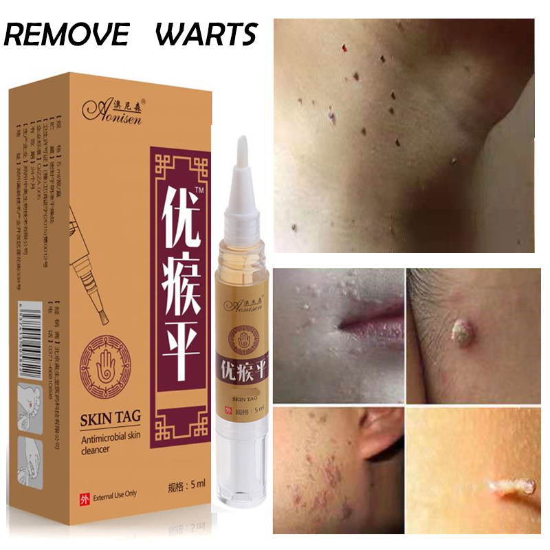 Wart Removal Liquid Fast Remove Skin Tag Remover Original Ointment