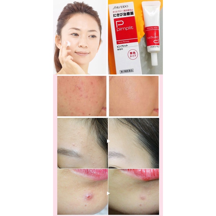 Kem Chấm Mụn Shiseido Pimplit Nhật Bản - Tuýp 18g