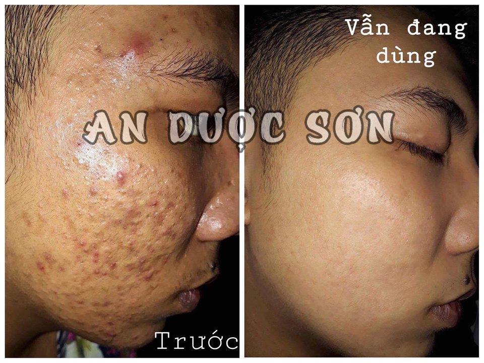 Bộ Ngừa Mụn An Dược Sơn Đánh Bay Mụn
