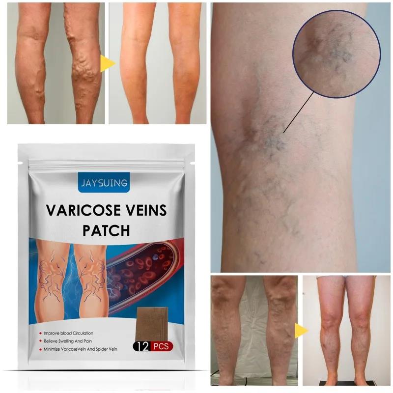 New%20model%20Varicose%20Veins%20Patch%20Relief%20Leg%20Vasculitis%20Spider%20Varicose%20Vein%20Patches%20Varicose%20Veins%20For%20Legs%20Improve%20Blood%20Foot%20Health%20Care%20-%20Image%203