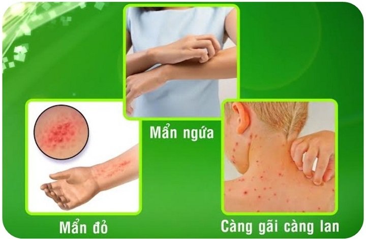 The original thủy (Siro target board thủy) -Board itching, Locket, allergic rashes skin