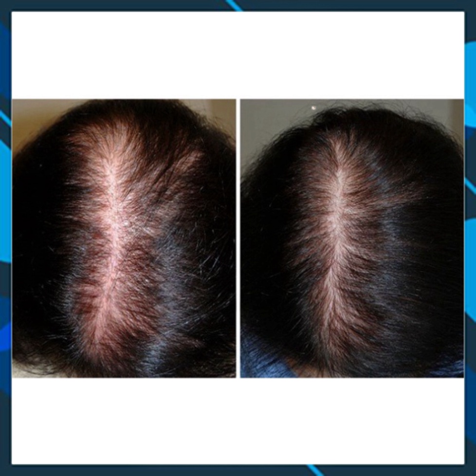 Xịt mọc tóc Minoxidil Bailleul 2% 5% 60ml