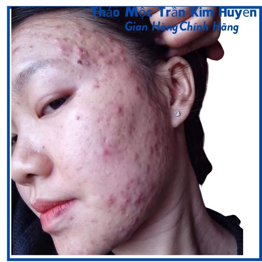 Serum Mụn Trần Kim Huyền