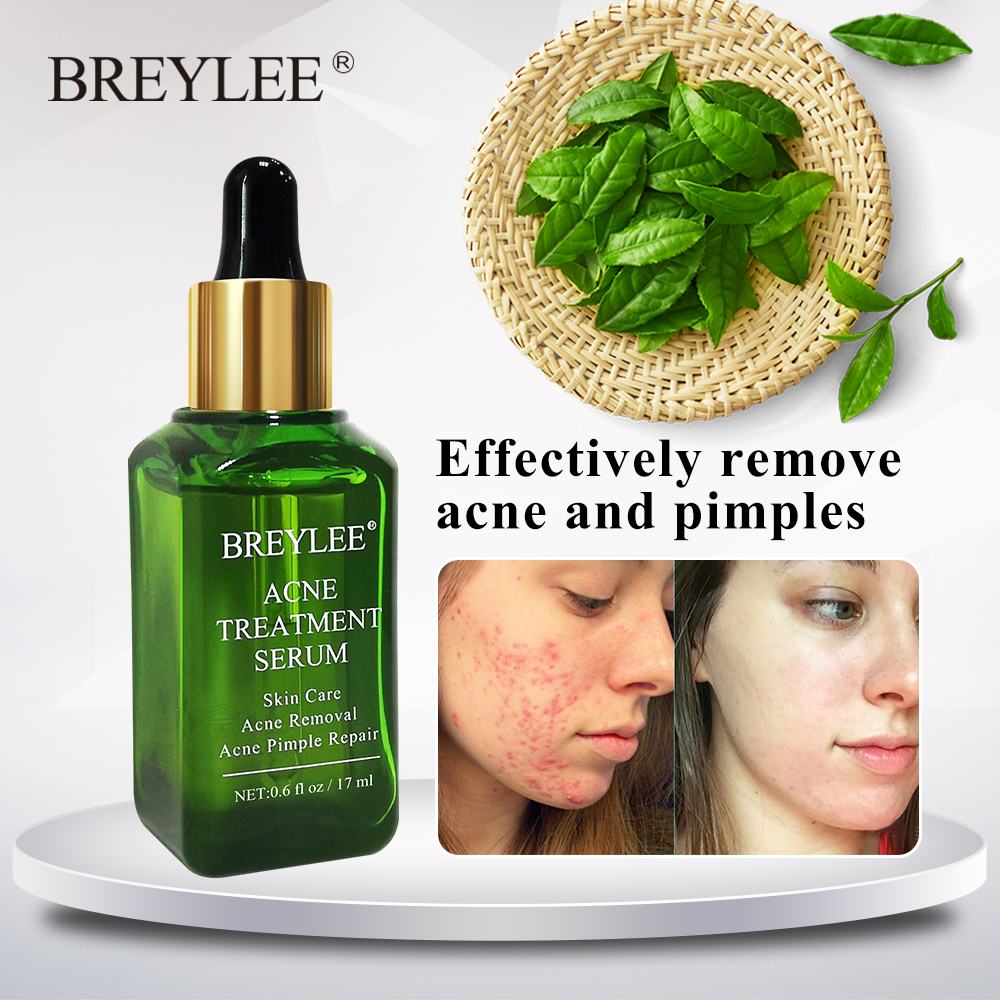 breylee acne treatment serum