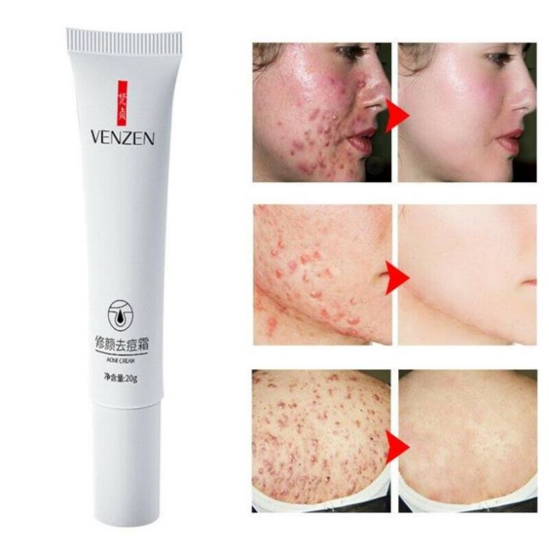Tuýp kem bôi mụn của bioaqua