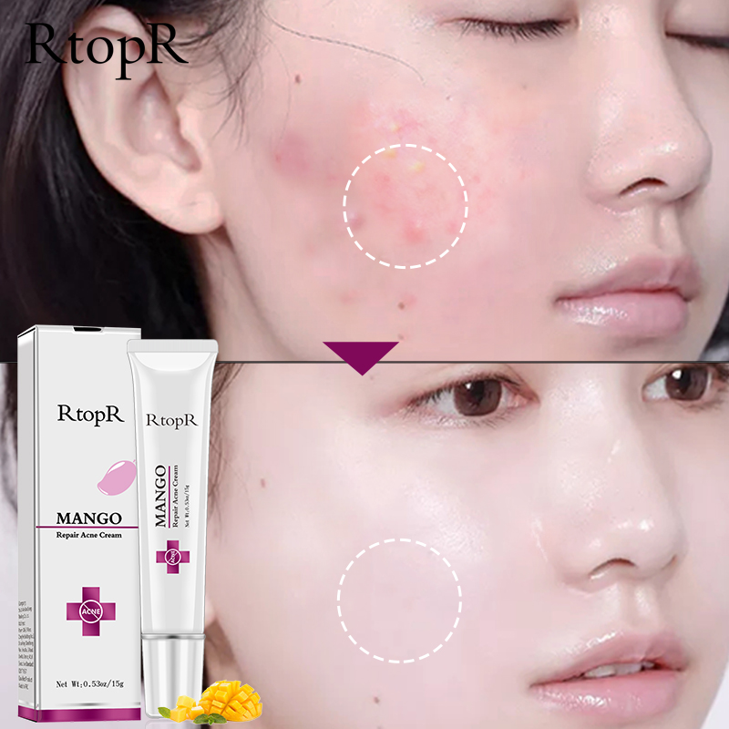 rtopr mango repair acne cream