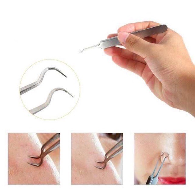 NHÍP GẮP MỤN THẦN THÁNH HÀN QUỐC
