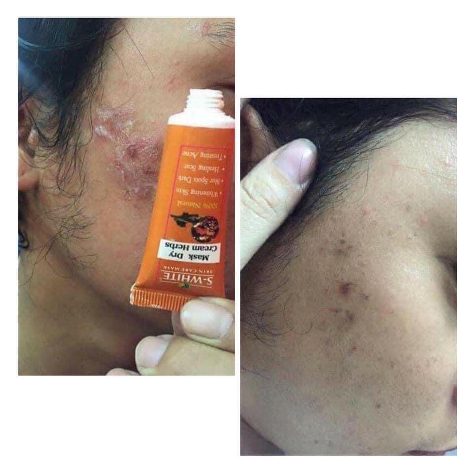 [HCM]TUÝP CAO LẺ SWHITE