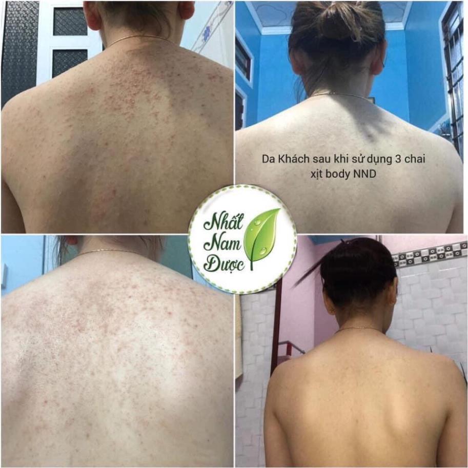Xịt mụn lưng Hoàng Thiên Sâm 100ml