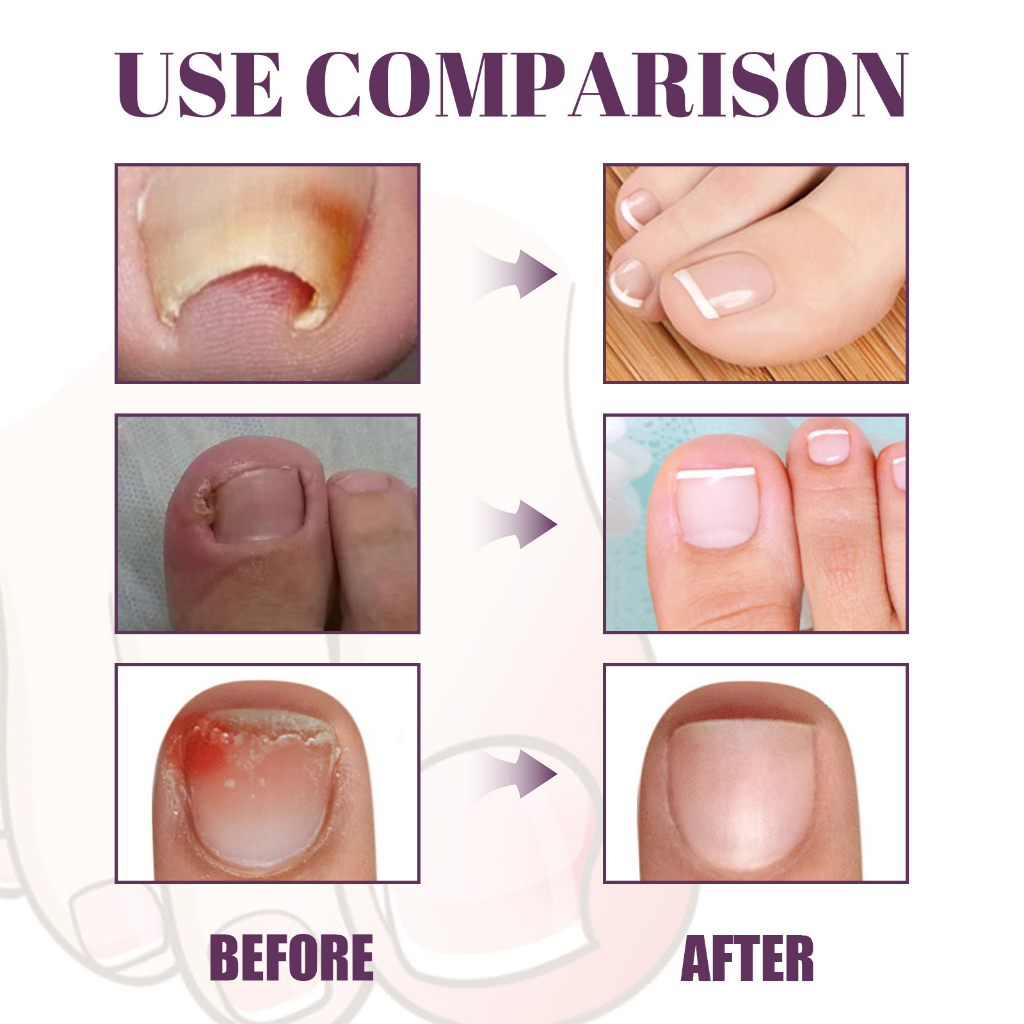 Bộ 20 Miếng Dán Chỉnh Sửa Móng Chân Mọc Ngược