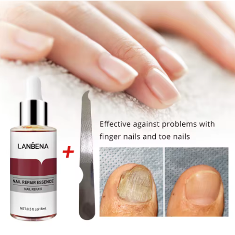 %E3%80%90Exclusive%20Discount%E3%80%91%20LANBENA%20Fungus%20Care%20Remove%20Onychomycosis%20Toes%20Nourish%20Brighten%20Hands%20Feet%20Product%20Repair%20Suitable%20Women%20Nail%20Pepair%20Essencs%20-%20Image%206