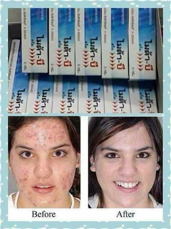 Kem đặc khắc phục nám, lang ben, đồi mồi Myda-B Thái Lan