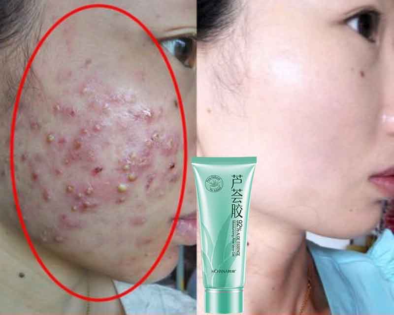 gel lô hội