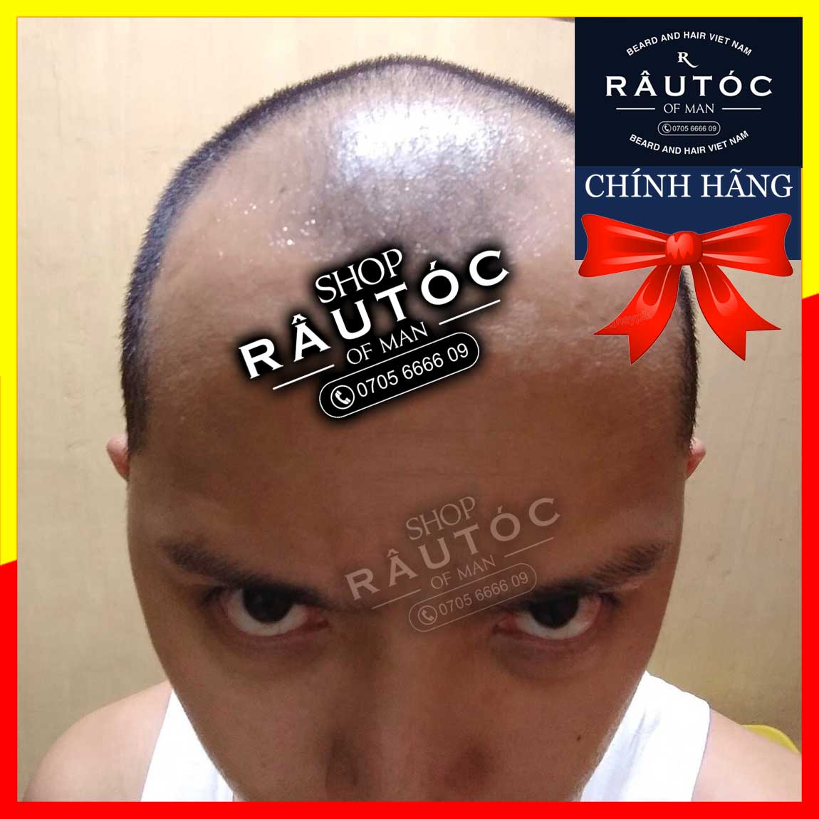 [HCM]Minoxidil 5% Rogaine