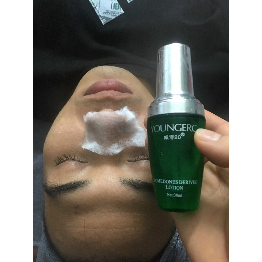 Ủ Mụn Young -QL 90