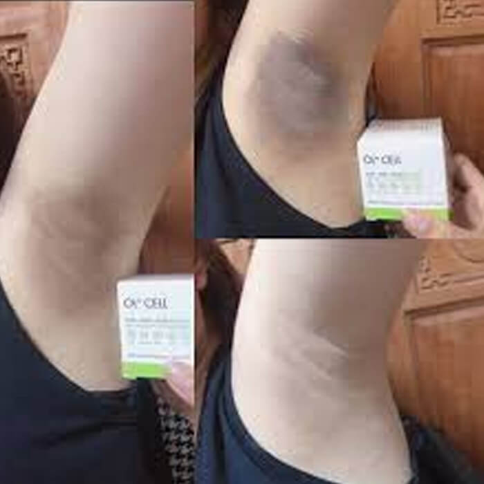 Kem Trị Thâm Nách Thâm Môi Thâm Đầu Gối OL-CELL