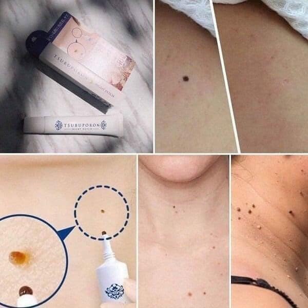 🥰🥰KEM TRỊ MỤN RUỒI TSUBUPORON NIGHT PATCH  NHẬT BẢN 🥰🥰