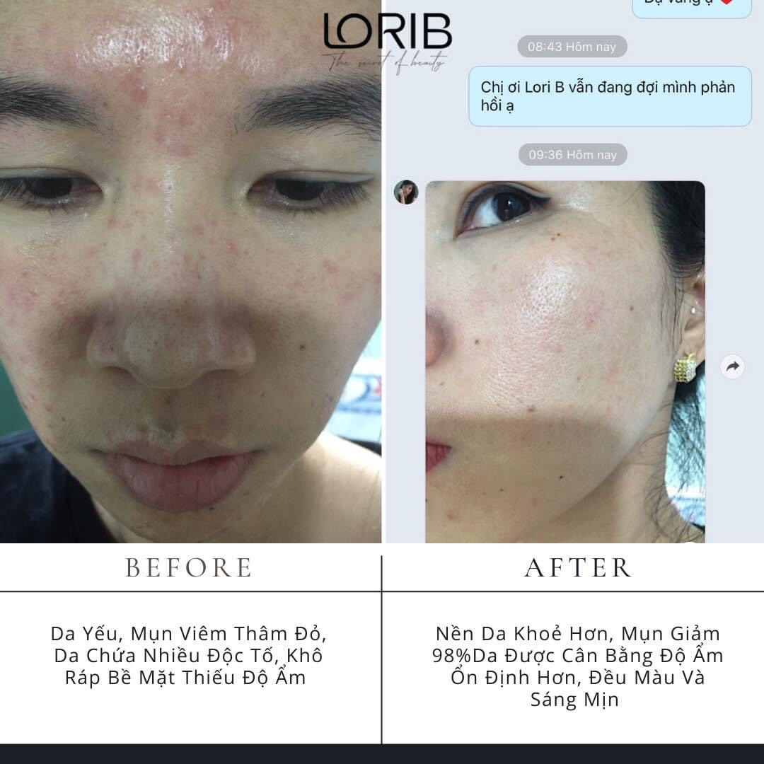 Kem mụn thảo dược Lori B 10ml