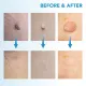 Natural Painless Auto SKIN TAG Removal kit Skin tag bands Remover Device New  Skin Tag Removal. 