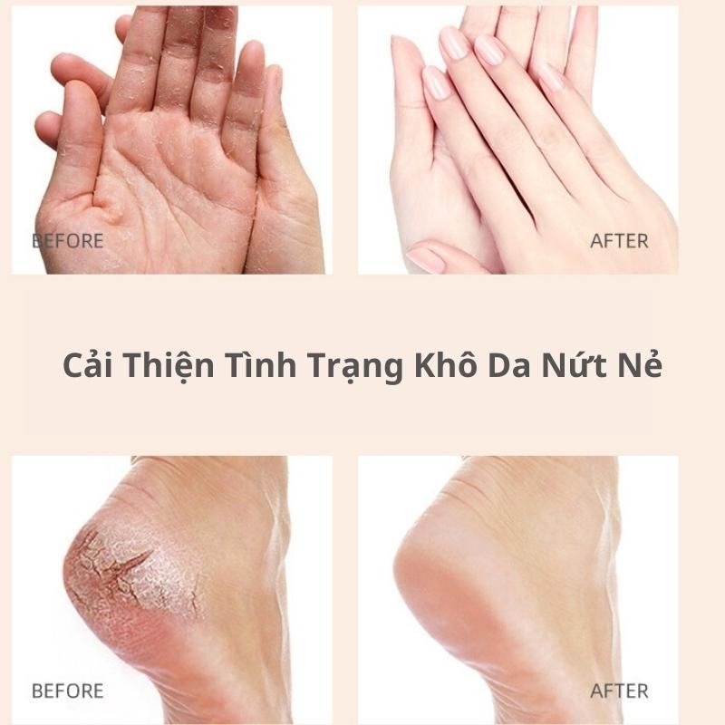 Kem giảm nứt môi gót chân tay 75g