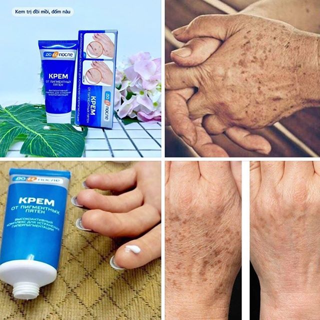 Kem tay kpem trị đồi mồi, vết nám, sạm, đốm nâu da tay kpem 50ml