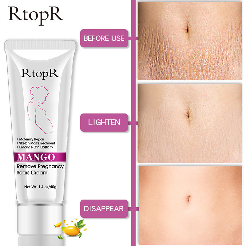 rtopr stretch mark cream
