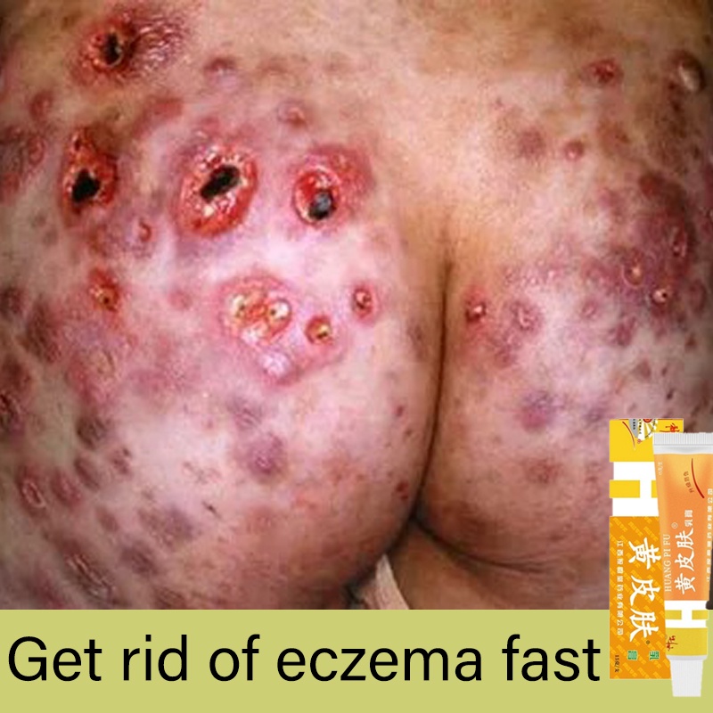 Chính Hãng Psoriasis Dermatitis Eczema Pruritus Psoriasis Skin Rash Care
