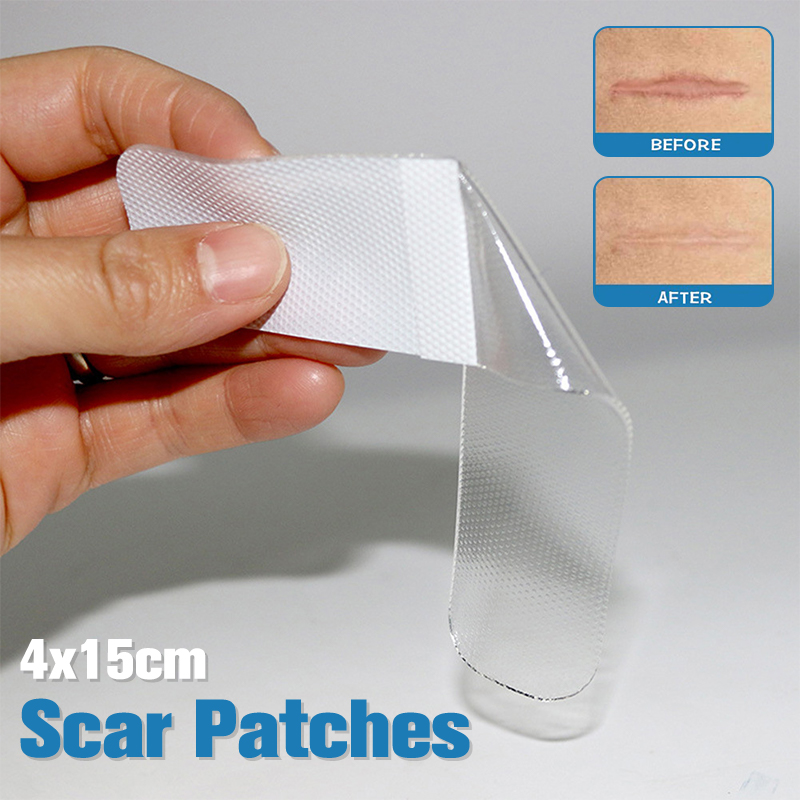 4x15cm%20Scar%20Patches%20Remove%20Silicone%20Gel%20Sheet%20Treatment%20Patch%20Ear%20Correctors%20Burn%20Wounds%20Efficient%20Surgery%20Scar%20Tape%20Skin%20Repair%20BOYUAN%20-%20Image%205