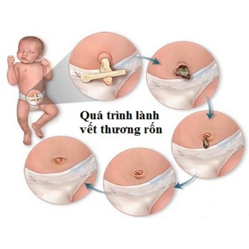 Băng Rốn Đông Fa / 1 Hộp 3 Chiếc ( Đã Tiệt Trùng )