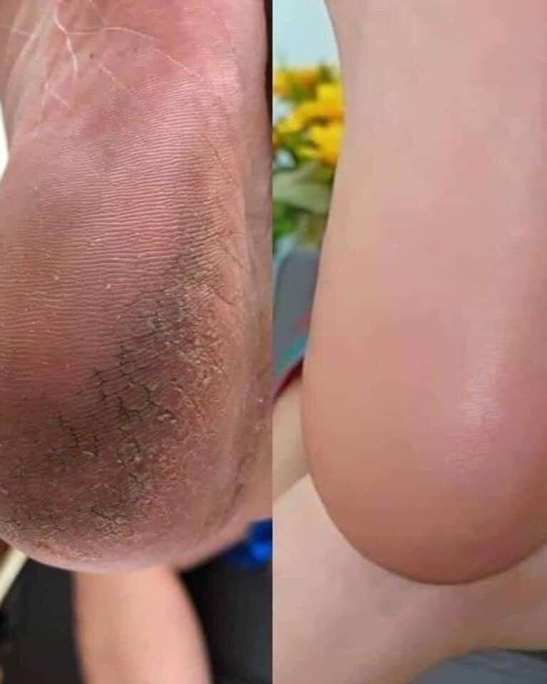 DỤNG CỤ CHÀ GÓT CHÂN BALEA