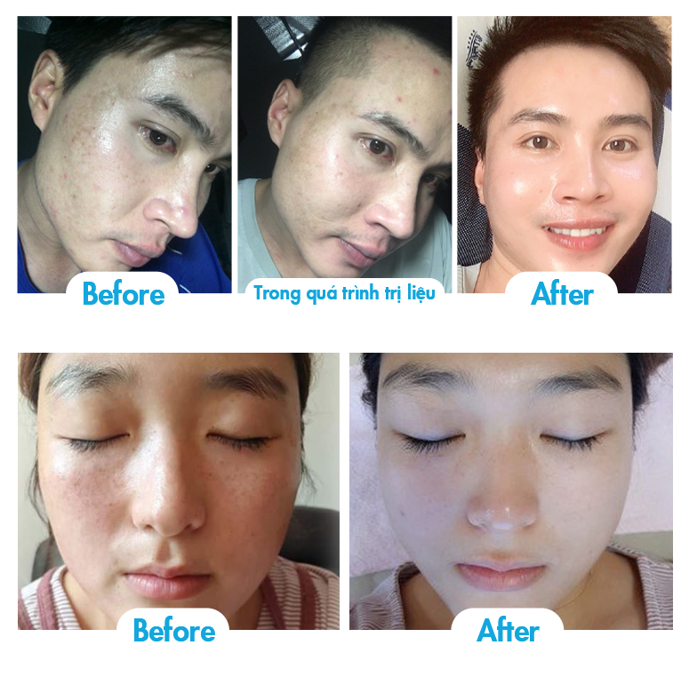 Siêu vi kim trẻ hoá da 10ml