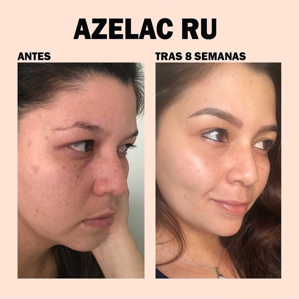 [CHÍNH HÃNG] Serum Sesderma Azelac Ru Liposomal Sáng Da Mờ Thâm Nám