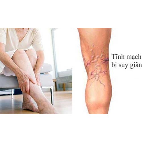 Kem Giãn Tĩnh Mạch Của Nga