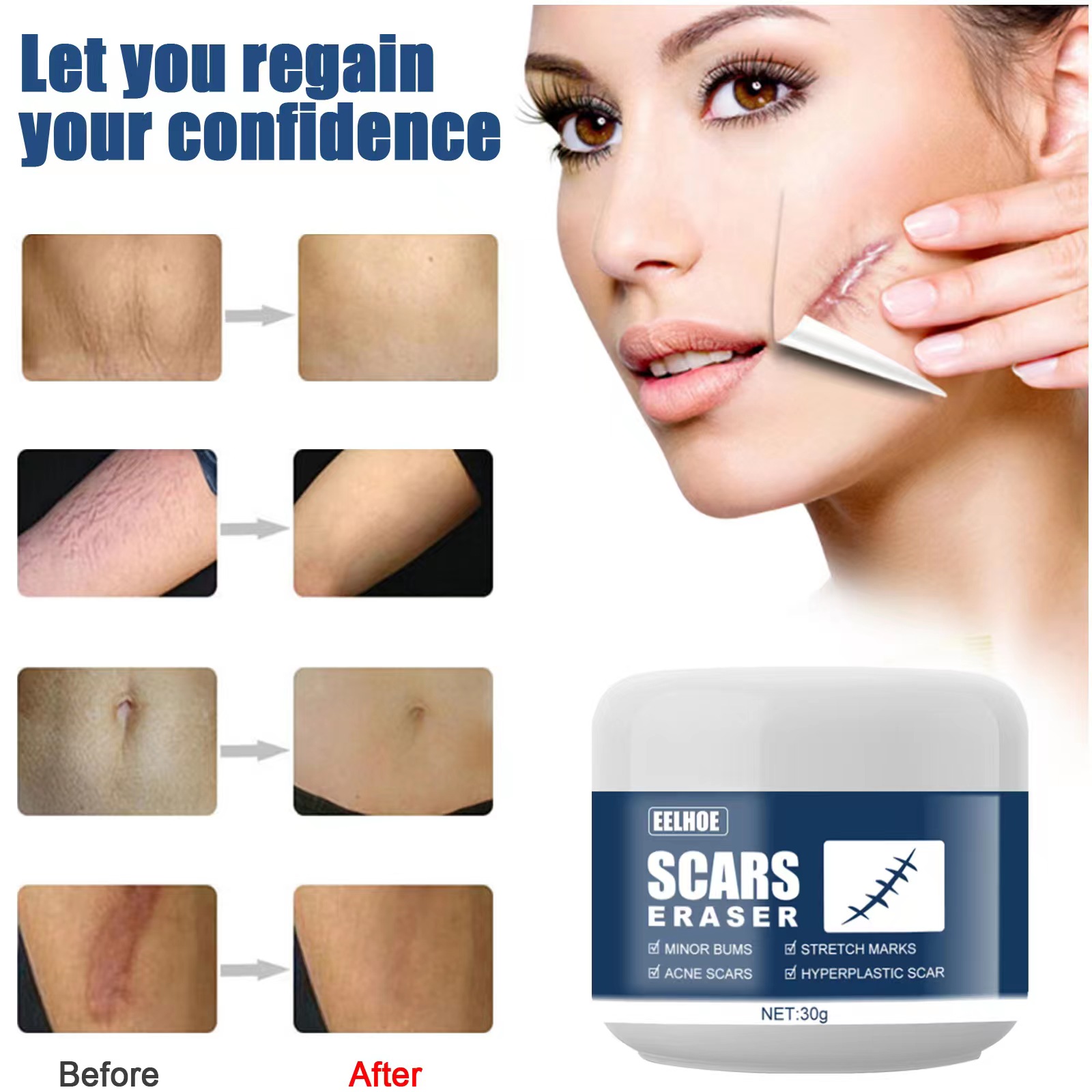 EELHOE SCARS ERASER ACNE SCARS Lazada PH