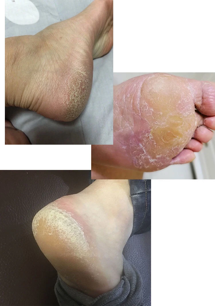 Yuanyan%20Foot%20Cleanser%20Exfoliator%20Softener%207%20Seconds%20Remove%20Dead%20Skin%20Calluses%20Foot%20Mask%20Anti-Cracked%20Heel%20Enhancer%20Nail%20Pedicure%20Kit%20-%20Image%202