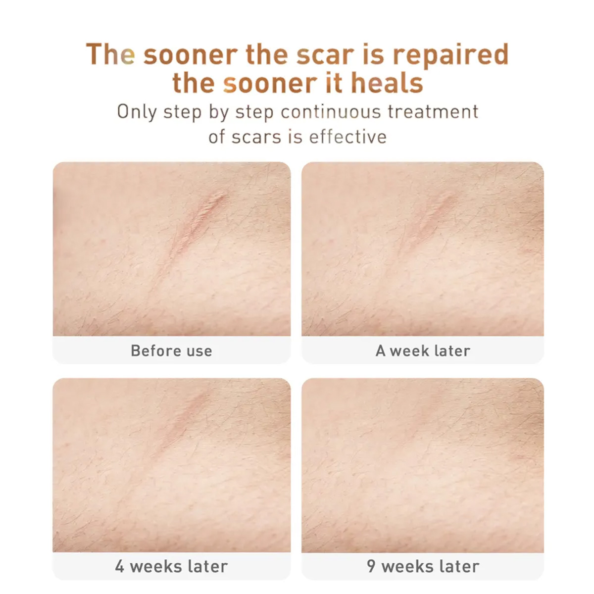 TCM%20All%20New%20Scar%20Cream,%20Acne%20Scar%20Removal%20Cream,%20Skin%20Repair%2030G%20Lanbena%20-%20Image%205
